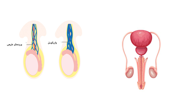 تفاوت بیضه سالم با واریکوسل