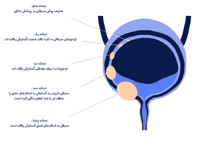 مراحل ابتلا به سرطان مثانه