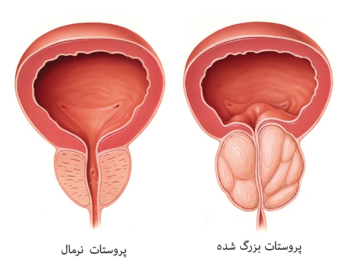 مقایسه پروستات نرمال و بزرگ شده1