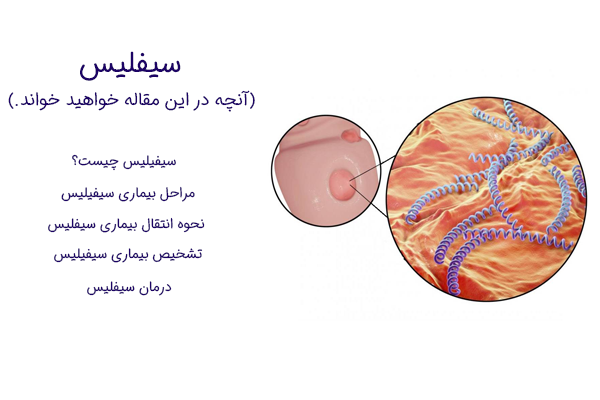 سیفلیس